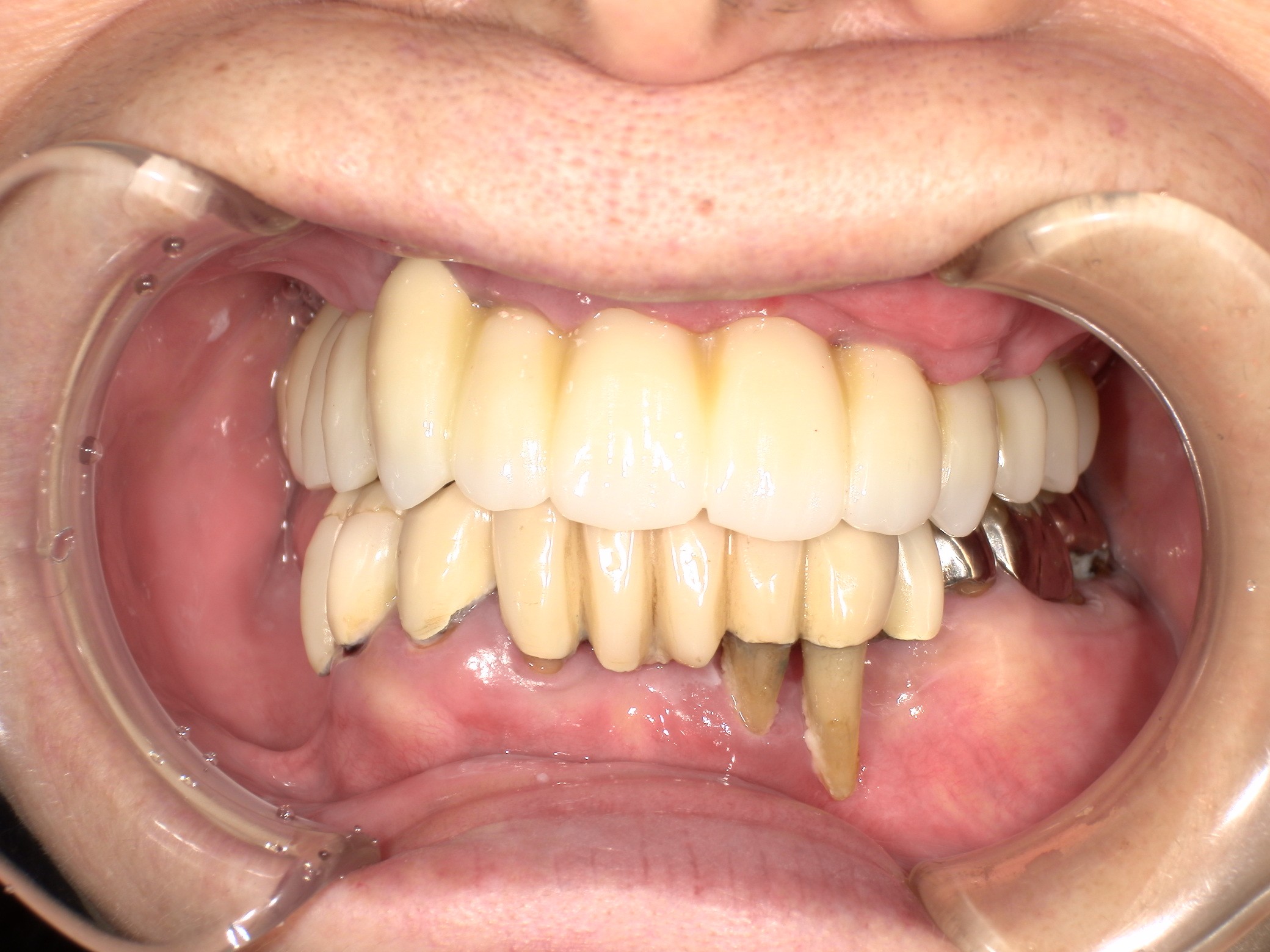 インプラント治療後