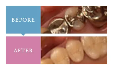 審美歯科での症例