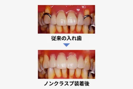 超弾性入れ歯（ノンクラスプデンチャー）