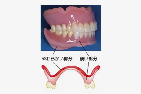 シリコン入れ歯
