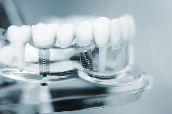 インプラントの装着