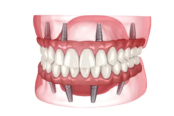 オールオンフォー（ALL ON 4）