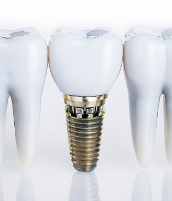 インプラント治療