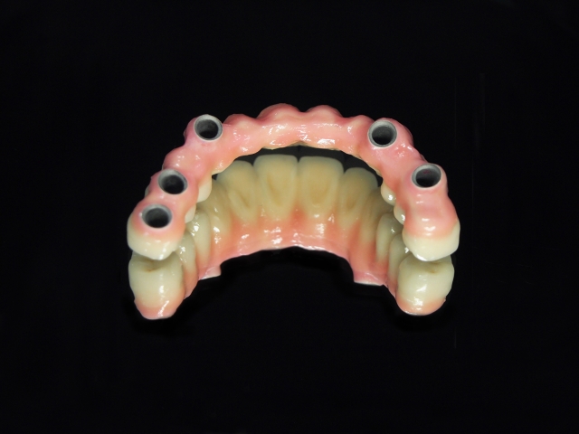 オーバーデンチャー（アタッチメント）