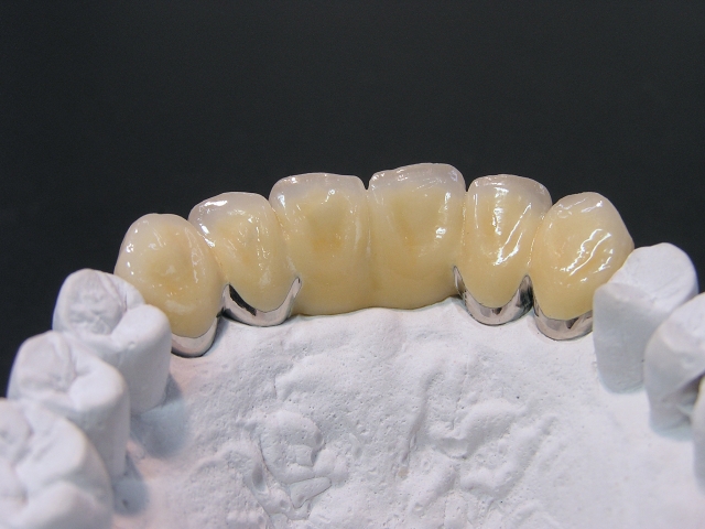 メタル付セラミック