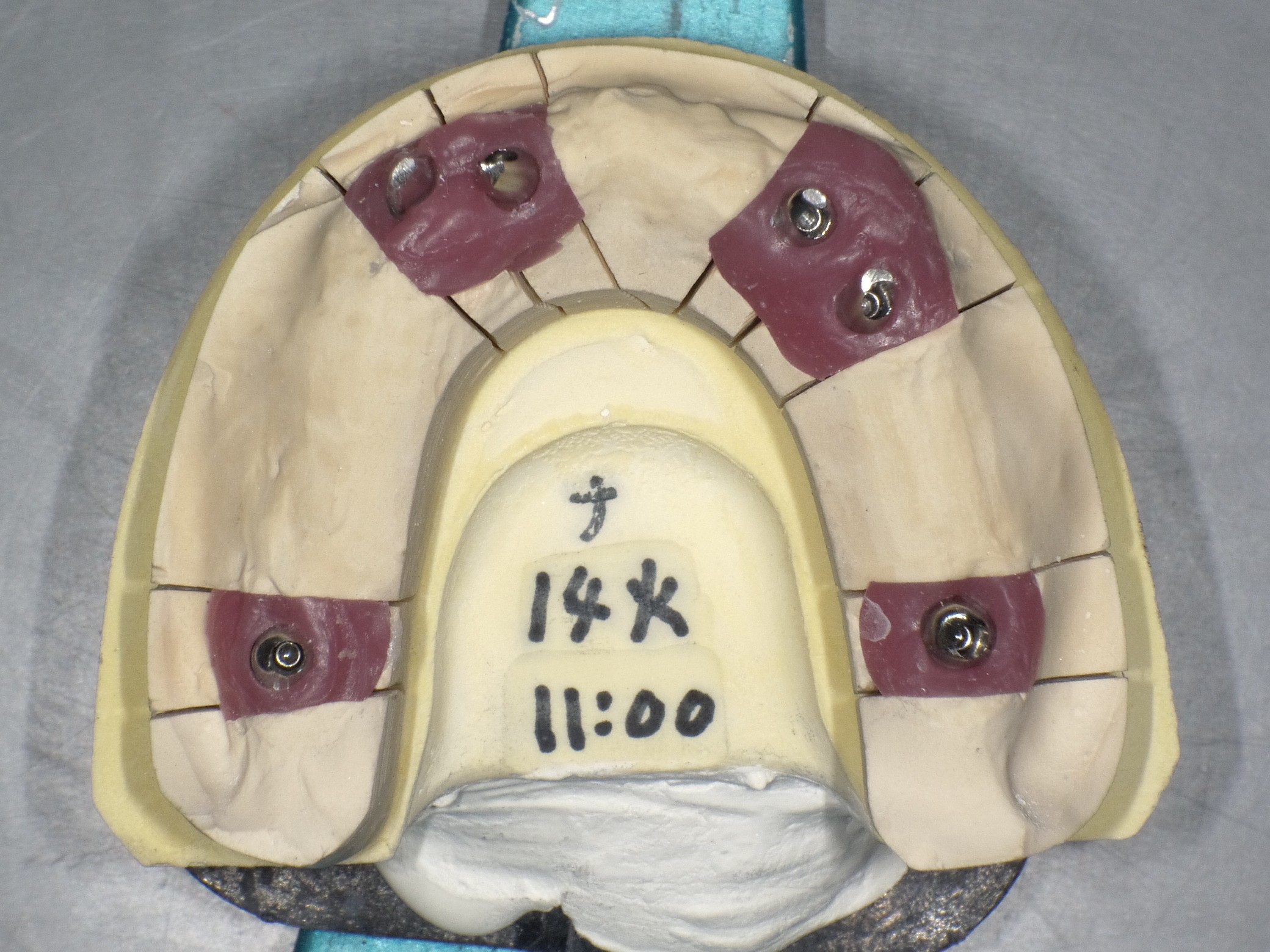 インプラント手術画像①