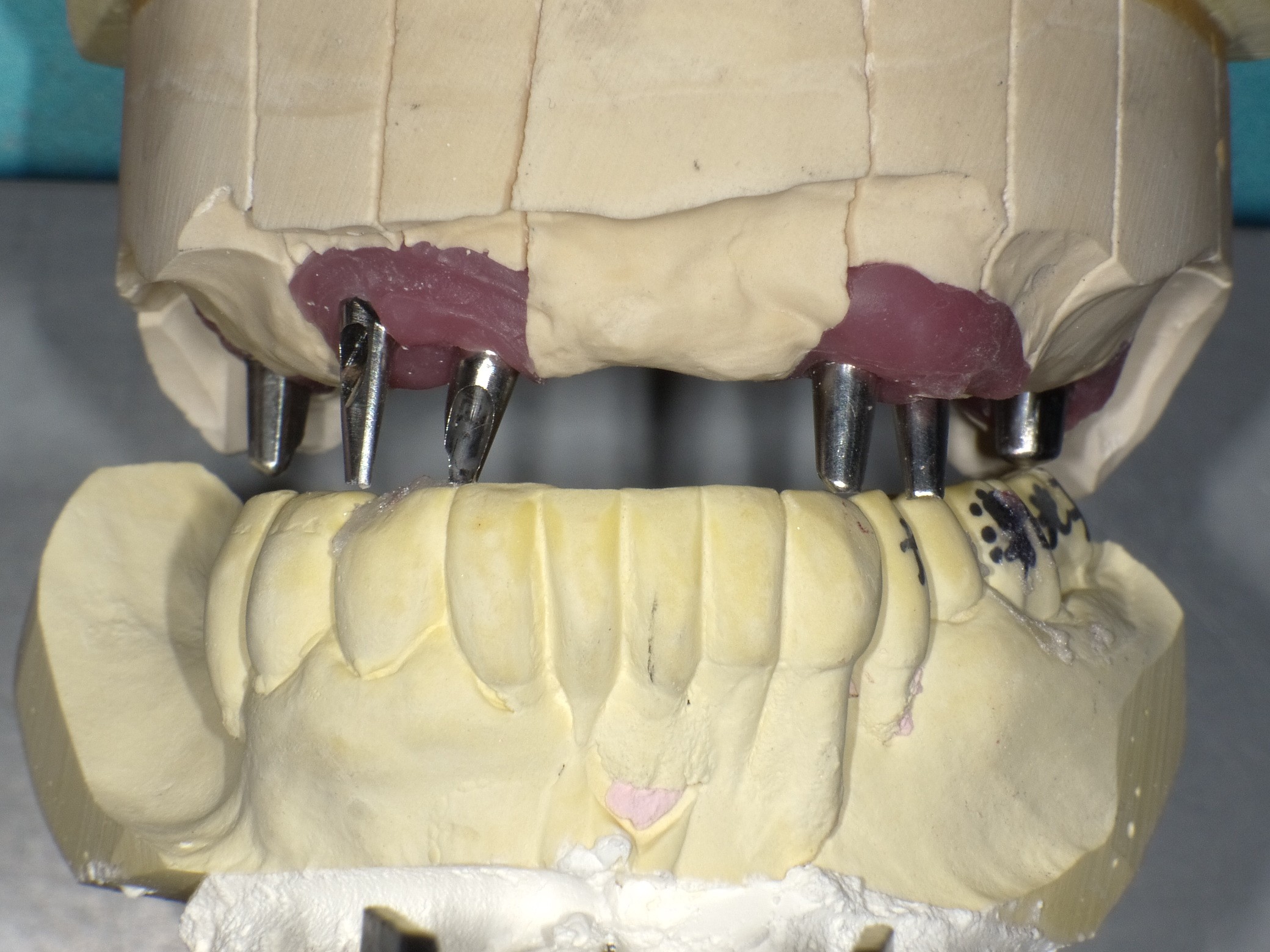 インプラント手術画像①